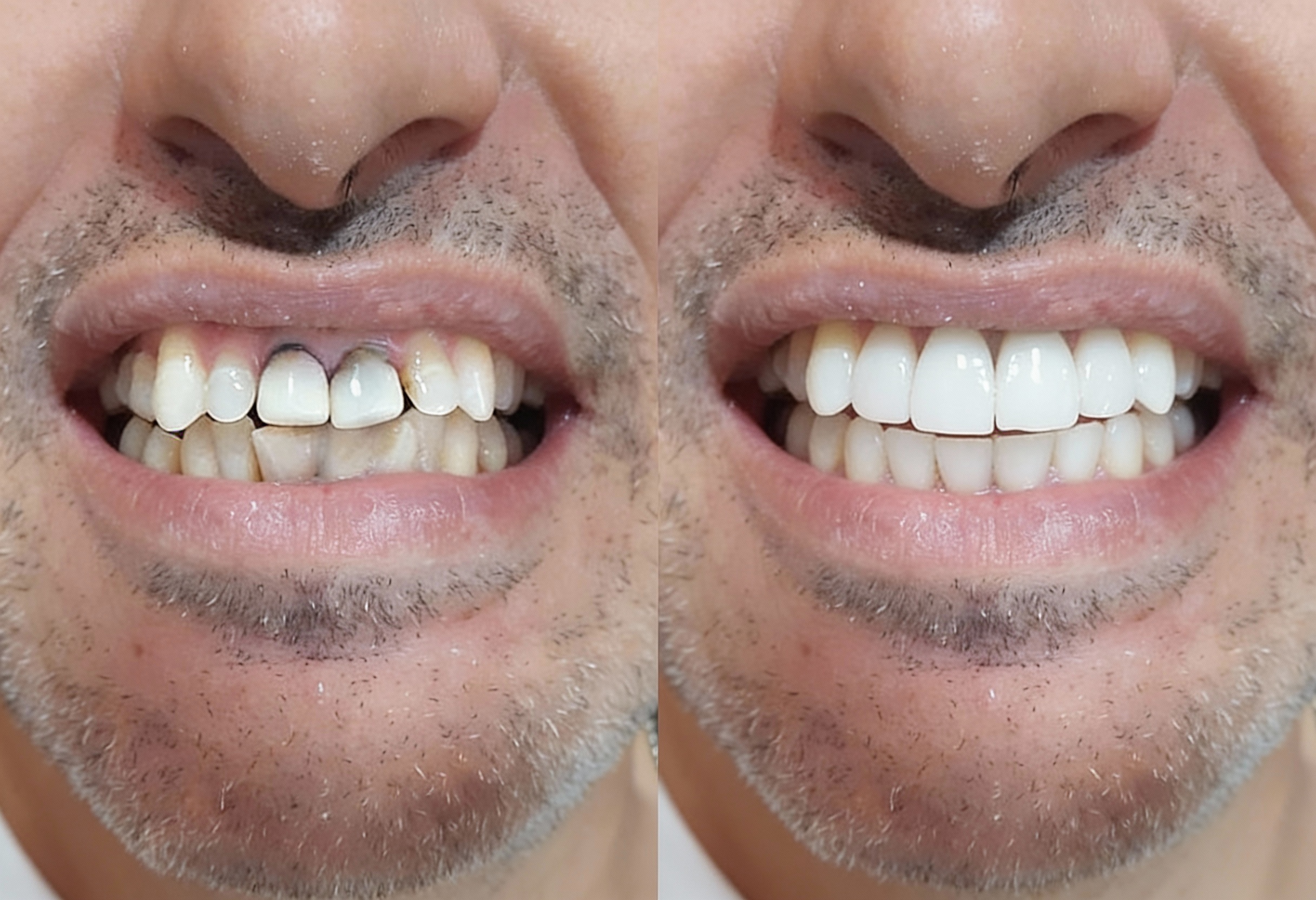 Caso 1 - Reabilitação estética